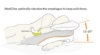 Picture of MedCline Reflux Relief and Lateral Positioning System